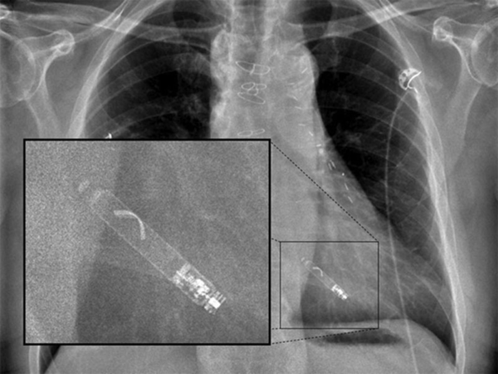 city labs betavoltaic battery leadless pacemaker, pacemaker battery